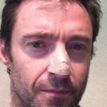Hugh-Jackman-skin-cancer-jpg